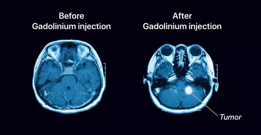 Comparison of MRI before 